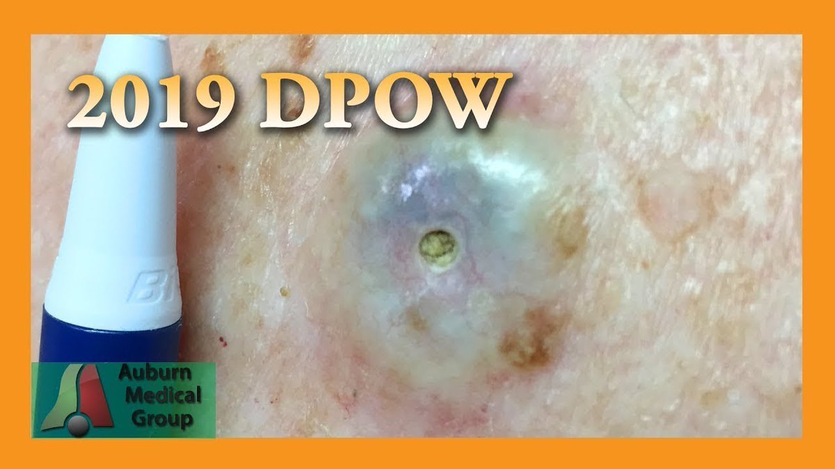 The Biggest Dilated Pore Of Winer