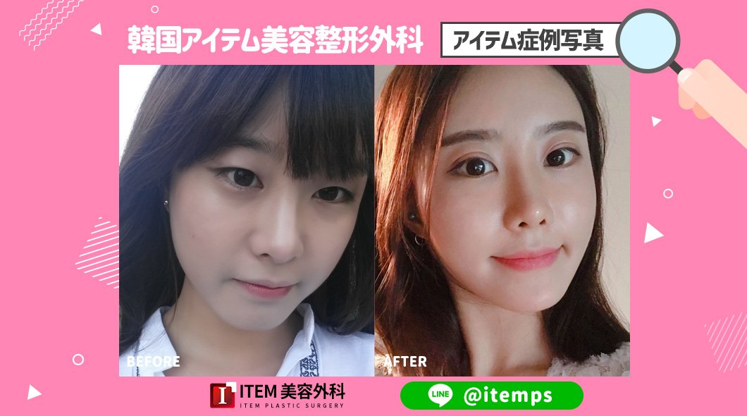 O Xrhsths Item アイテム 美容外科 Sto Twitter 韓国整形 手術内容 目 自然癒着 タレ目形成 鼻 脂肪移植 大きな目のに すらっとした鼻になりましたね Line Id Itemps Line追加 T Co Nmfkoji3k3 韓国鼻整形 韓国二重整形 鼻整形 目整形