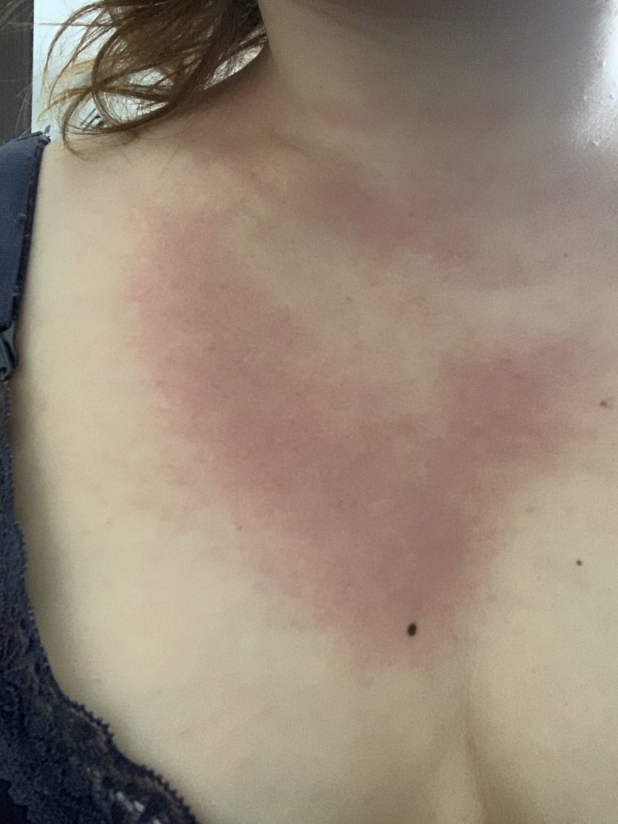 水アレルギー Twitter Search