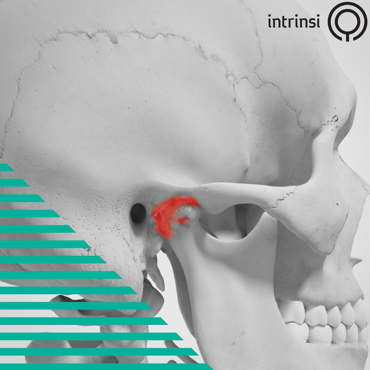 The temporomandibular joint (TMJ) acts as a hinge that connects your jawbone to your skull on both sides. Pain in this joint causes discomfort in the jaw and surrounding area. BUT there are treatments to help with this pain and discomfort! Inquire today at intrinsi.janeapp.com