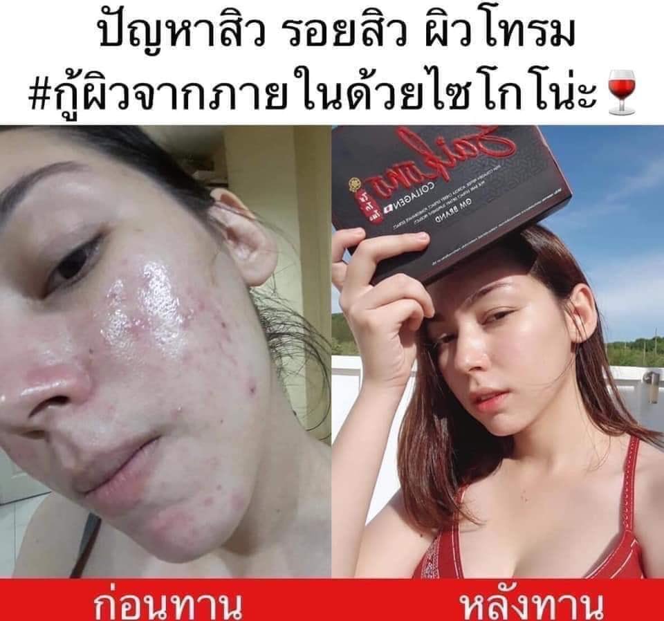 Suraiiz's tweet photo. สนใจสั่งซื้อสอบถาม>>> https://t.co/rCKgNyfqB3
คอลลาเจนนำเข้าจากญี่ปุ่น แถมไม่มีกลิ่นคาว ช่วยในเรื่องสิว ผิว ผม เล็บ กระดูก 🍷
ปล. เห็นผลตั้งแต่กล่องแรก 💯 %
ของแท้แน่นอนค่ะ เป็นตัวแทนค่ะ
ราคา 390 บาทค่าาา
พร้อมส่ง #ไซโคโนะคอลลาเจน🍷🇯🇵 #saikonocollagen #saikonocollgen #saikono❤️ https://t.co/OP3XMKIO42