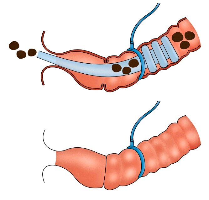 Techniques in Coloproctology Journal tweet media