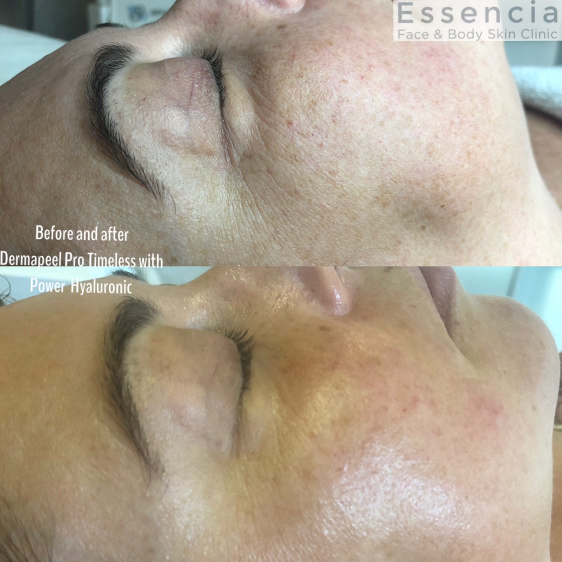 ClinicDavid's tweet photo. Amazing results after just 1 session of our NO DOWNTIME Dermapeel Pro Timeless combined with Power Hyaluronic 😍 
#hyaluronicacid #peel #nodowntime #facial #skincare https://t.co/9OlM3bZdDE