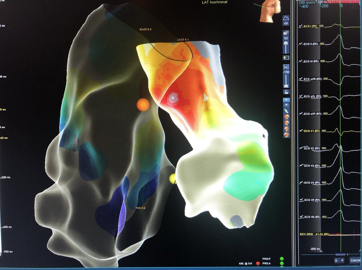AMatthews0's tweet image. Case from a few weeks ago @MUSChealth by @JRWinterfield. “PVC Double Play”. Total 🗺⏱ with #HDgrid 11m 45s. Clinical PVC mapped just under LCC. Secondary PVC mapped to Mod band. Both silenced by #Flexability. #mapmoreburnless @AbbottCardio #epeeps @EPeeps_Bot