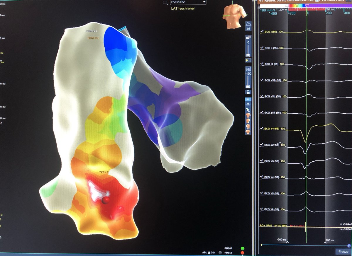 AMatthews0's tweet image. Case from a few weeks ago @MUSChealth by @JRWinterfield. “PVC Double Play”. Total 🗺⏱ with #HDgrid 11m 45s. Clinical PVC mapped just under LCC. Secondary PVC mapped to Mod band. Both silenced by #Flexability. #mapmoreburnless @AbbottCardio #epeeps @EPeeps_Bot