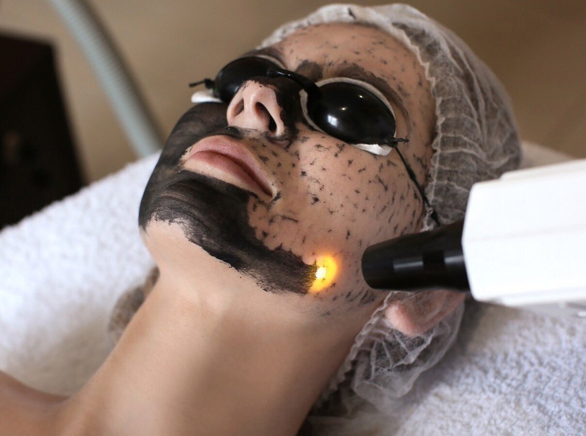 Cilt gençleştirme amacıyla uygulanan ve son dönemde oldukça popüler olan #karbonpeeling uygulaması aslında lazer destekli yapılan cilt soyma işlemidir.