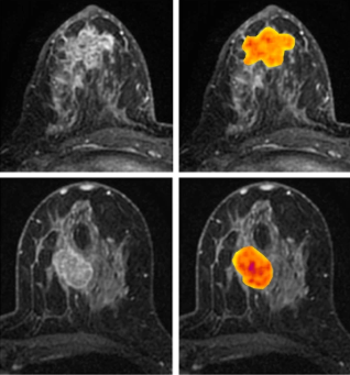 CE-MRI as a way to monitor tumor biology in #breastcancer: bit.ly/2oDmVXZ #imaging #MondayMorning #Cancer #openaccess