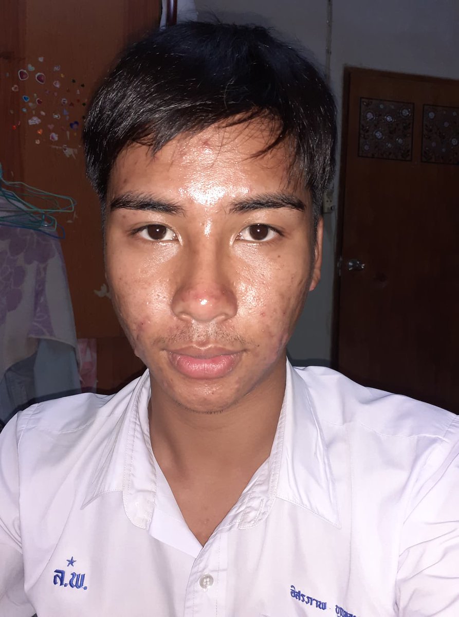 ployly96079486's tweet photo. จากที่ไม่เคยชอบถ่ายรูป หนีผู้คน ไม่อยากพบใคร วันนี้กล้าโชว์แบบไม่อาย 
หนักสุดในชีวิต จะไม่มั่วครีมอีกเลย !!! 

#สิว #ใช้จริงรีวิวจริง #ใช้ดีบอกต่อสิว 
#ใช้เองรีวิวเอง #วิชอโล #20บาท #howtoperfectสิว #howtobeauty 
#HowtoPerfect https://t.co/vB8HN0w18u