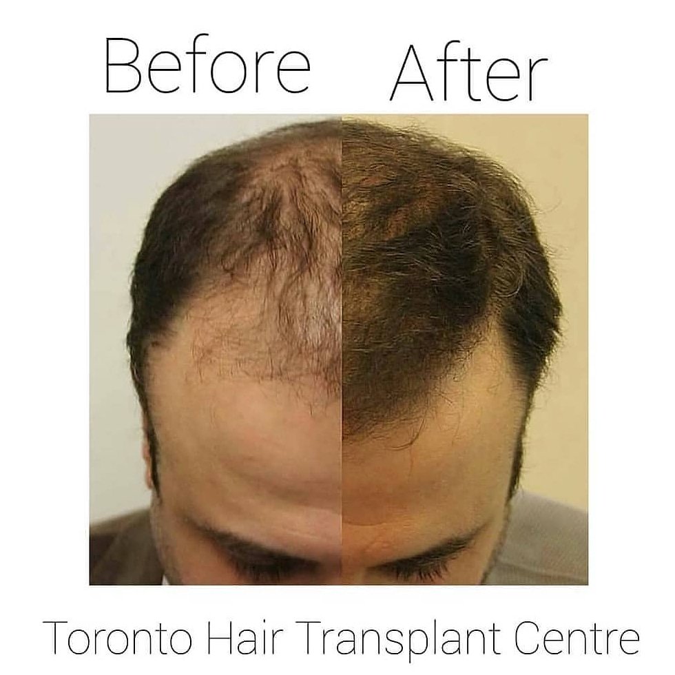 Dr. Rob Jones & Dr. Jon Huber (@torontohairdrs) / Twitter Dr. Rob Jones & Dr. Jon Huber (@torontohairdrs) / Twitter