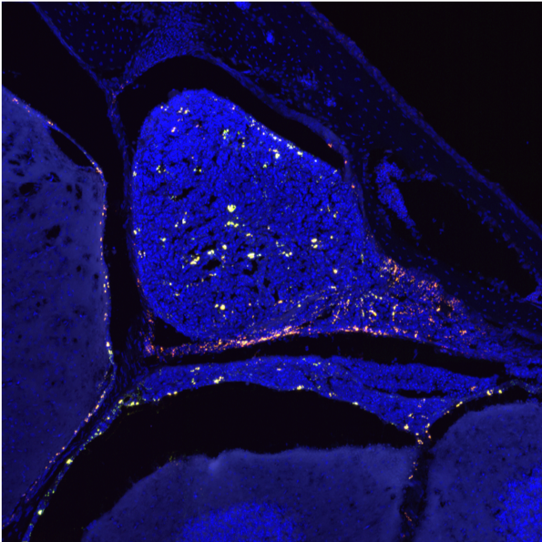 SirianniLab's tweet photo. Where do #nanoparticles go after they're injected into cerebrospinal fluid? Everywhere, and that's a good thing. We're banking that this approach can be used to engineer better chemotherapy to treat pediatric brain cancer https://t.co/m6ABCZxENq https://t.co/8NAKa8aQ0h