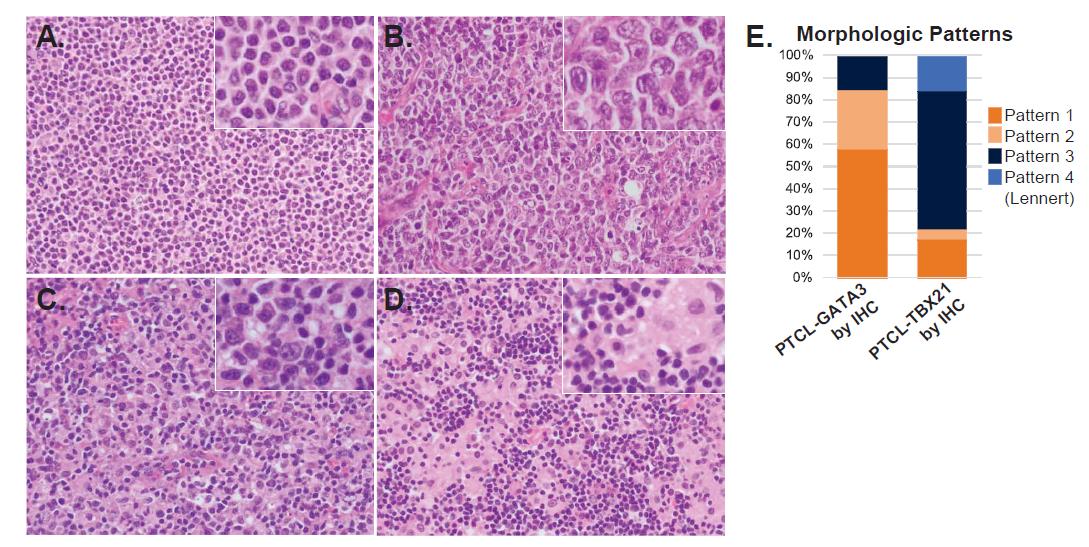 evemariecrane's tweet image. ~1/3 of T-cell #lymphoma fall into PTCL, NOS category. 
@CAmadorMD &amp;amp; #hemepath #dreamteam from the LLMPP consortium provide an IHC diagnostic algorithm for prognostic GATA3 and TBX21 subtypes. They also have distinct morphologic features. 🙏Testing it out! bloodjournal.org/content/early/…
