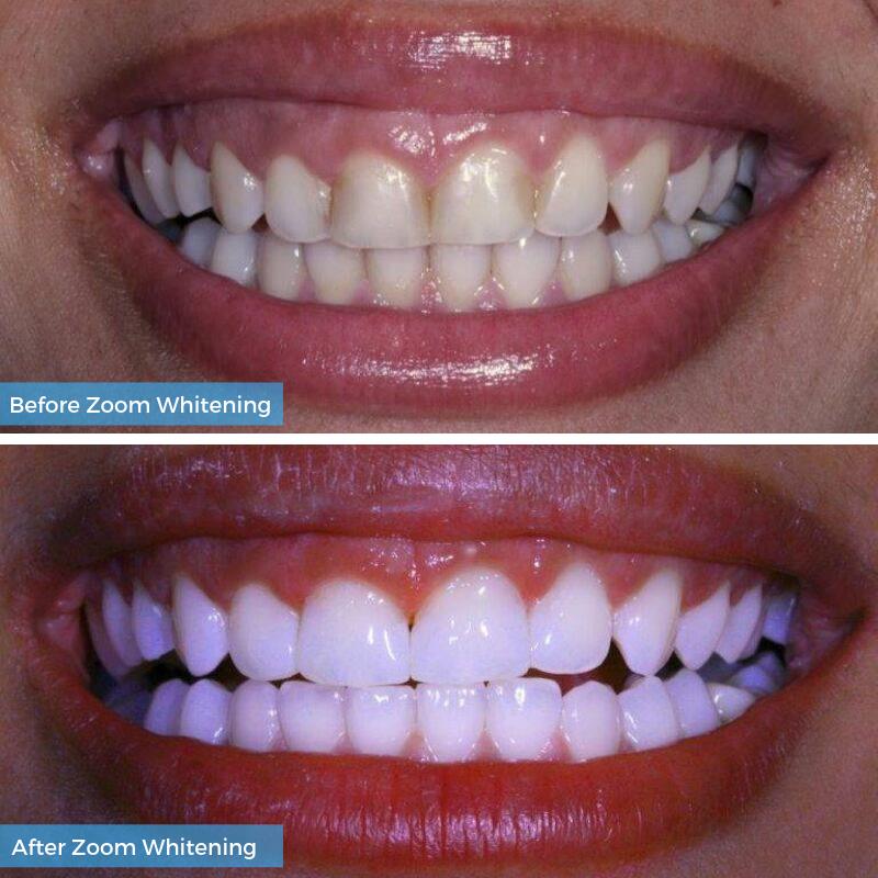 Dentaloffice's tweet photo. Nothing says beautiful better than a healthy, white smile 😁 Don’t wait a moment longer! Call 480-867-1727 now for brighter, healthier-looking teeth. #teethwhitening #dentist #scottsdale #az https://t.co/F4F5Eriytt