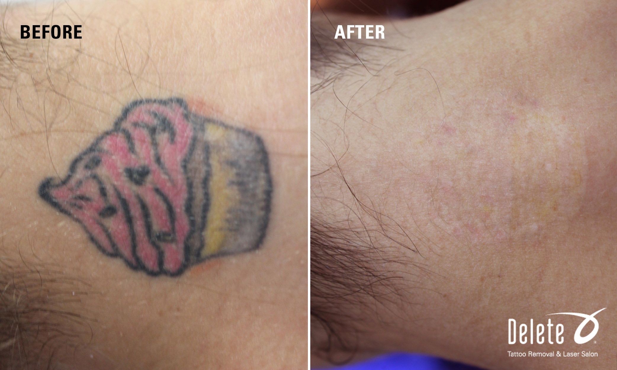 Delete Tattoo Removal & Medical Salon on Twitter: 