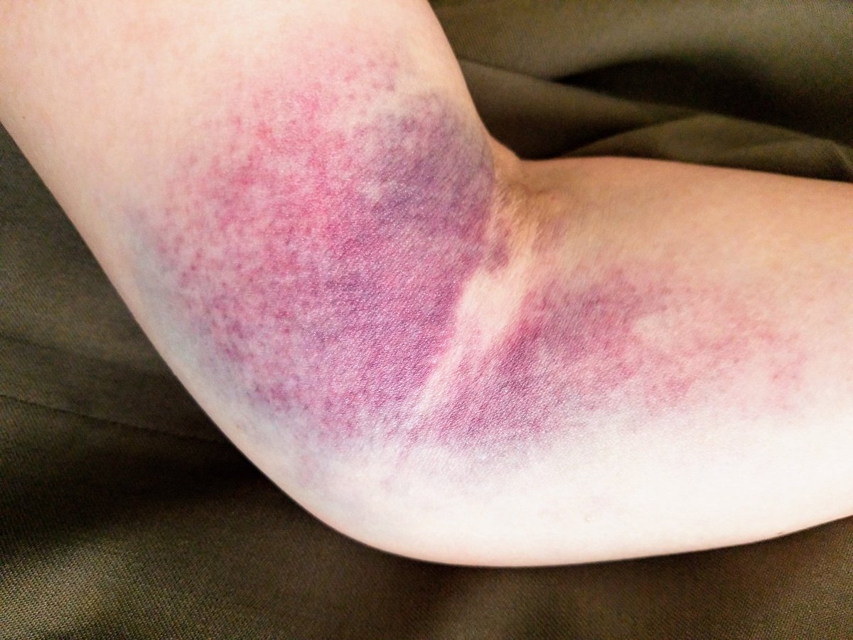 SkyStephens4's tweet photo. @VitalantLV
Before you ask for 
BLOOD DONATION
STOP injuring donors like you injured me. 
You could apologize me at least instead of covering up. 
Shame on you Vitalant.
@News3LV
@8NewsNow
@FOX5Vegas
@13NewsNow https://t.co/4WURab6J5q