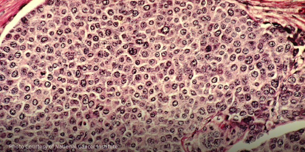 SCIDirector's tweet image. SCI Program Leader George Sledge found that two targeted treatments can extend the lifespan and delay the need for chemotherapy in women with HER2-negative metastatic #breastcancer. stan.md/2mnqtwF #bcsm #monarch2 @GeorgeSledge51