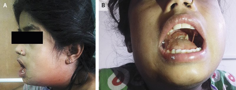 A 14-year-old girl presented with fever, neck swelling, and a grayish-white membrane in the oropharynx. A throat culture grew Corynebacterium diphtheriae. nej.md/2lDy3Tq