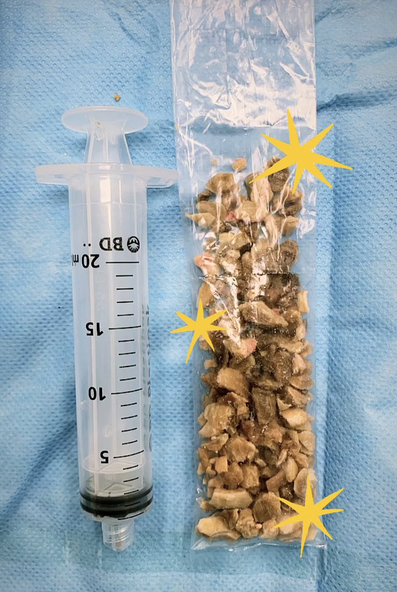 Karen Mendoza Bravo (@karenmbravo) on Twitter photo 52YO 🚺 Bilateral lithiasis, BMI 36 PCNL double tract ☄️ one of them (inferior calix) usg guided and without nephrostomy... a second look will be needed 🤯. <a href="/UroHRAEPY/">Urología HRAEPY</a> <a href="/juanjoselascano/">Dr Juan Lascano Gallegos</a> <a href="/PCNL_challenges/">PCNL challenges</a> (not available simple TC) #UroSoMe 52YO 🚺 Bilateral lithiasis, BMI 36 PCNL double tract ☄️ one of them (inferior calix) usg guided and without nephrostomy... a second look will be needed 🤯. <a href="/UroHRAEPY/">Urología HRAEPY</a> <a href="/juanjoselascano/">Dr Juan Lascano Gallegos</a> <a href="/PCNL_challenges/">PCNL challenges</a> (not available simple TC) #UroSoMe