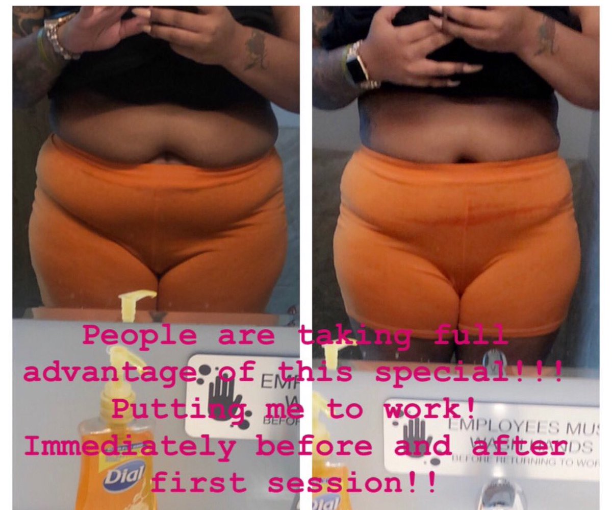 BToxthetics's tweet image. RESULTS!!!! #Atl #Miami #Botox #LipoCavitation #SmartLipo #Inktober #NursePractitioner #Beauty #Results #CampCreek #ForrestPark #WaistTrainer