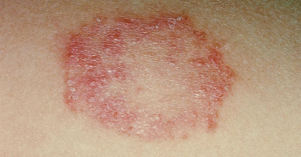 This Woman's Red, Ring-Shaped Rash Turned Out to Be a Sign of Anal Cancer