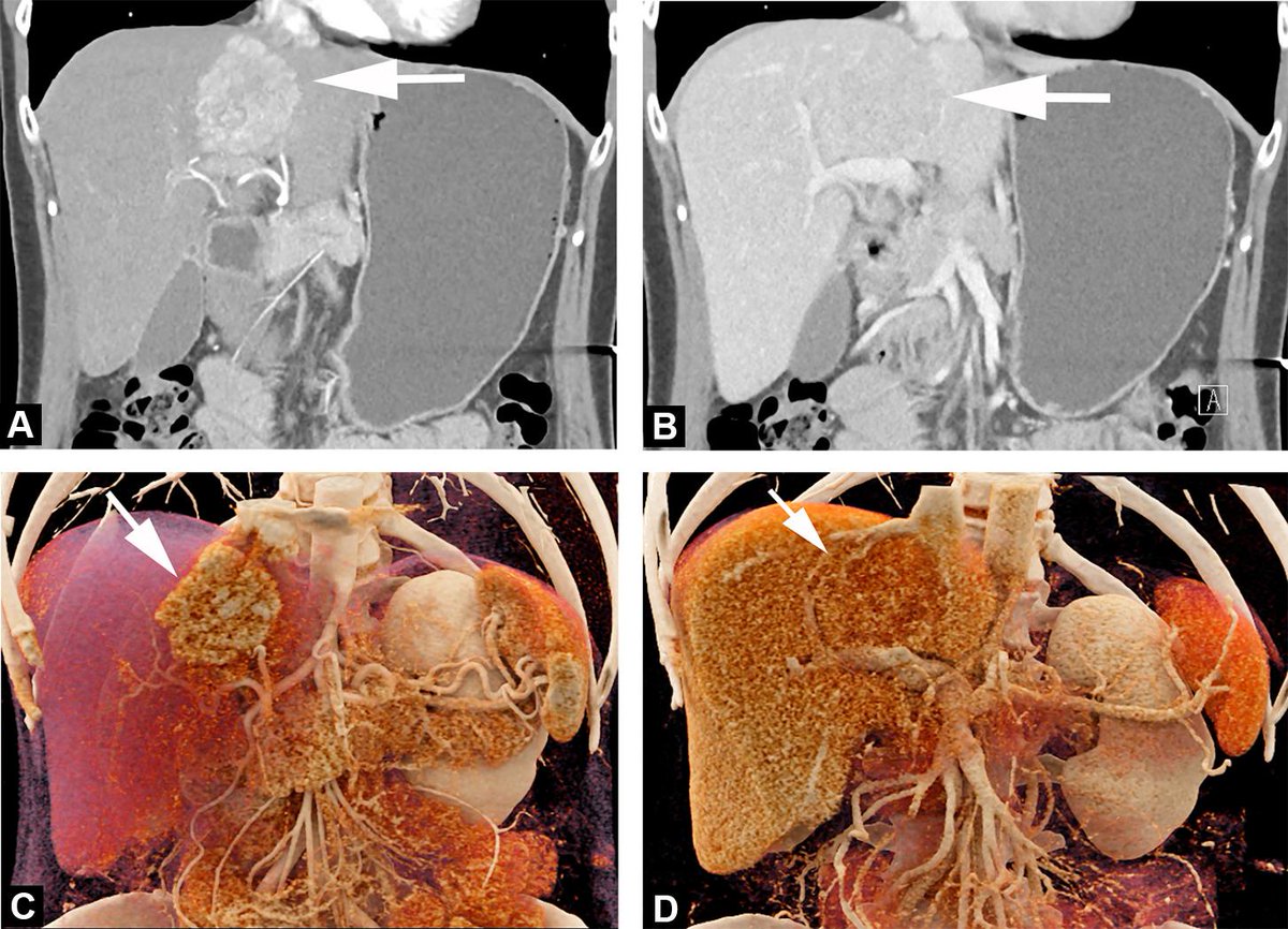 Cinematic rendering (CR) of focal liver masses. A review illustrating the potential application of CR in evaluations. bit.ly/2ntg6rA @SFRadiologie #3DImaging #CT #LiverMass #PretreatmentPlanning