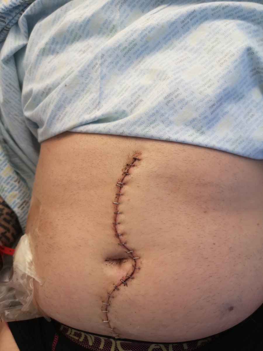 eck666's tweet image. It&apos;s been 21 days since I went under the knife and received my double organ transplant, all is going well and docs are happy with my progress, please join the donars list and save a life be someone&apos;s hero