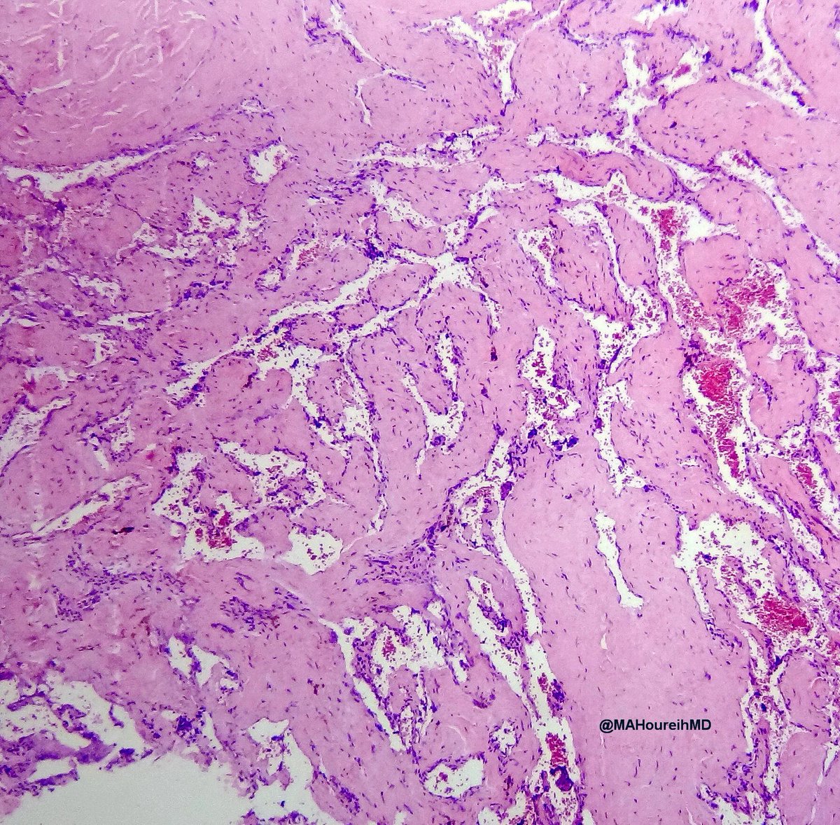 MAHoureih's tweet photo. #HeadandNeck #pathology #ENTpath Middle Age 👨 Parapharyngeal mass. Two sets of images. Believe me all images are from the same mass🕵️‍♀️ https://t.co/GH1ZicBT28
