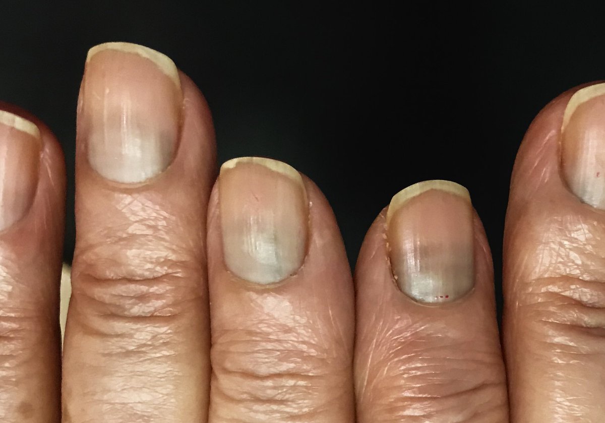 julianconejomir's tweet photo. Quimioterapia para cáncer de mama. Puede alterar las uñas, ademas del pelo. No te asustes, desaparece al suspenderla. #dermatologia #dermatology https://t.co/SrXZFxoqkk