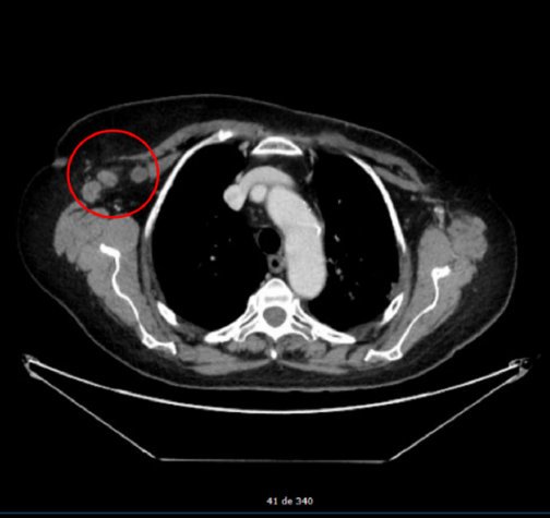 JCMT_CancerNews's tweet photo. Contralateral axillary metastasis: is surgical treatment the best option? | A Case Report by María Julia Giménez &amp; colleagues from the Department of Surgery, Fundación Instituto Valenciano de Oncología (IVO), Valencia, España.
https://t.co/TgJFnaxI4y https://t.co/u1hcrnX0ri