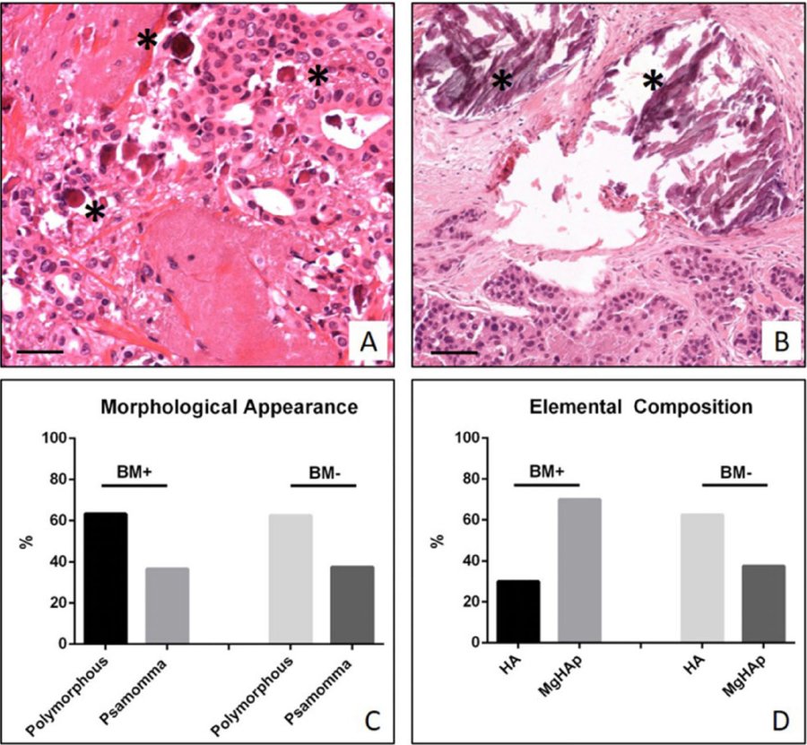 JCMT_CancerNews's tweet photo. Can microcalcifications’ characteristics predict the risk of breast cancer metastasis to bone? |
New article led by Prof. Elena Bonanno, Department of Experimental Medicine, University of Rome “Tor Vergata”, Rome, Italy. 
Read it here:
https://t.co/OXRvlhfIW0 https://t.co/kulggpPr6K