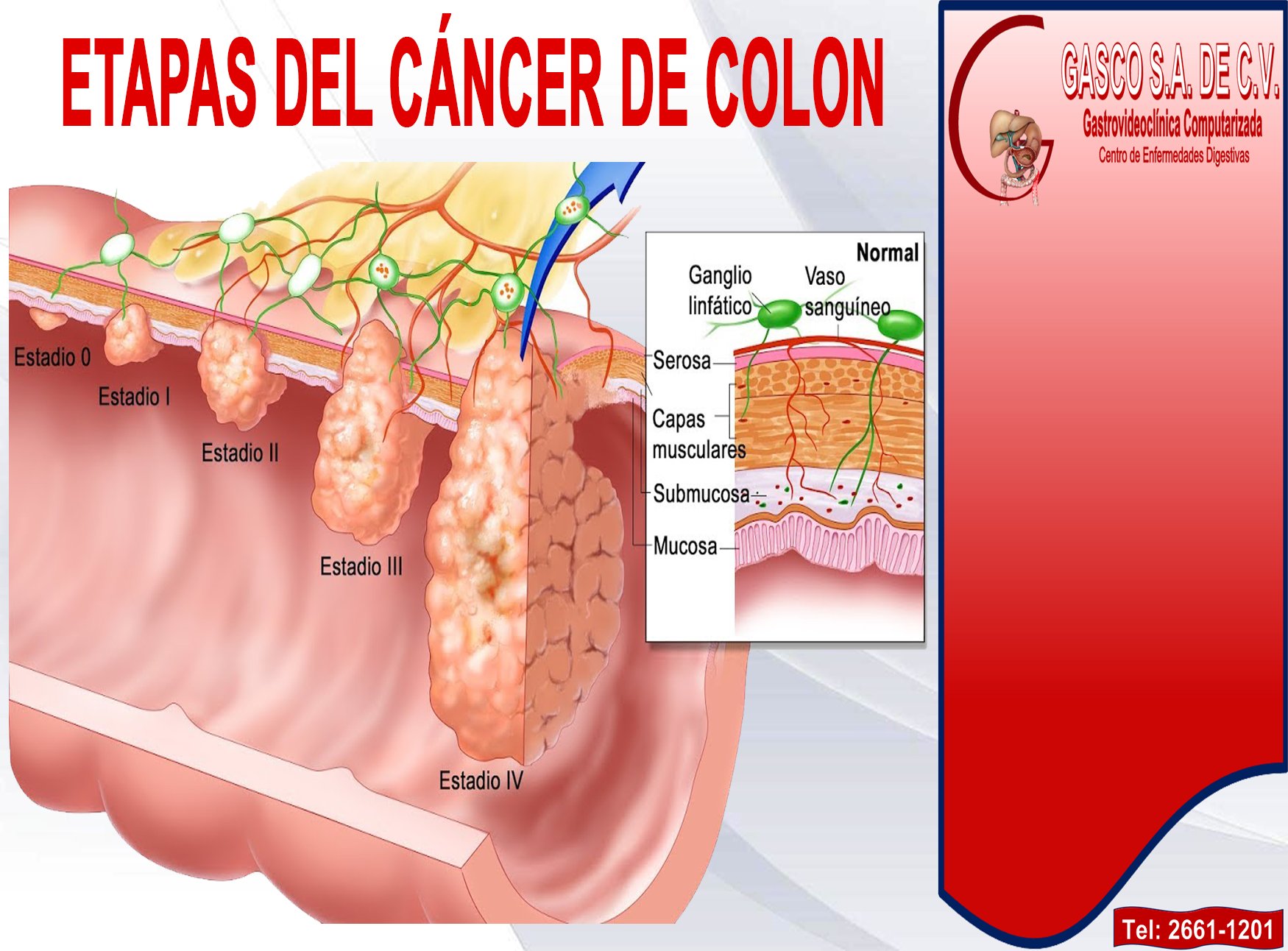 cancer de colon con ganglios afectados)