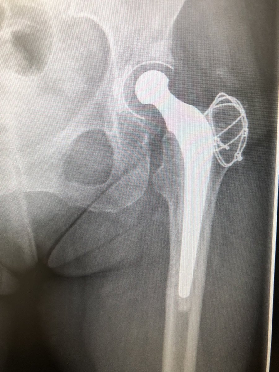 tim_n_board's tweet photo. Hip replacement done age 36, just seen in clinic age 72 with this X-ray. Half her life with a #charnley #longtermfollowup beat that #orthotwitter @wrightington16 @WWLNHS https://t.co/z2DHpGliGq