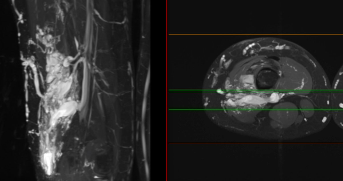 STASE technique for pets Vasc #Malformation that extends the entire thigh causing severe pain. Coils, balloon occlusion, dual access and STS to the rescue! <a href="/FIRVAmeeting/">FIRVA</a> <a href="/keithppereira/">Keith Pereira MD, #VIrad</a> <a href="/AriIsaacsonMD/">Ari Isaacson</a> <a href="/Team_VIV/">Vascular Inst of VA</a> <a href="/LessneVIR/">Mark Lessne, MD</a> <a href="/MaureenKohi/">Maureen Kohi</a> <a href="/ISETNews/">ISET</a> <a href="/RajNarayanan67/">Raj Narayanan</a> <a href="/docTPlive/">Tino Peña</a> <a href="/SIRRFS/">SIR RFS</a>