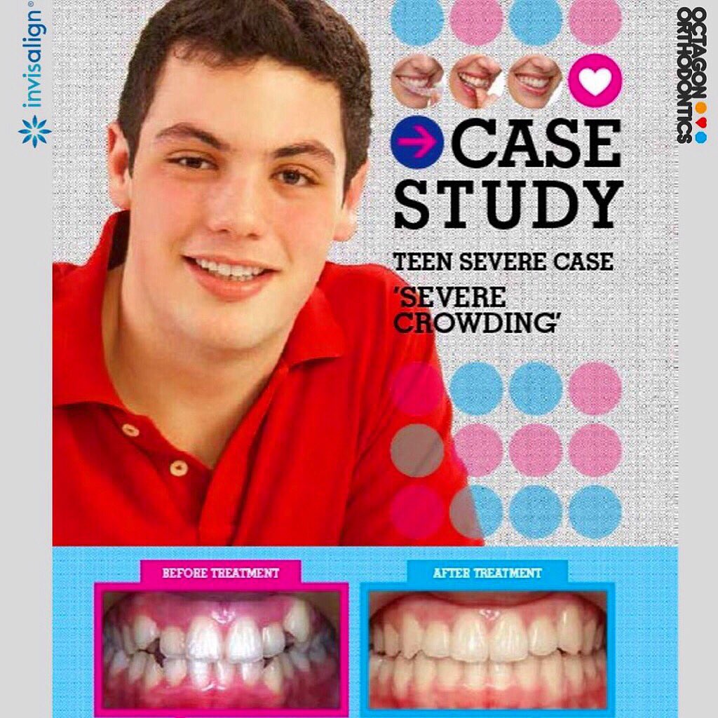 OctagonOrtho's tweet photo. Patient started treatment at 13 years old. 26 months of Invisalign treatment - Corrected crossbite + alignment of upper/lower teeth.

For more info please go to our websites:
https://t.co/OfNGHCE3Gb
https://t.co/8BMfjduurq
https://t.co/XFuoPHH2Rq

#octagonorthodontics #invisalign https://t.co/IAJIMLhvpn