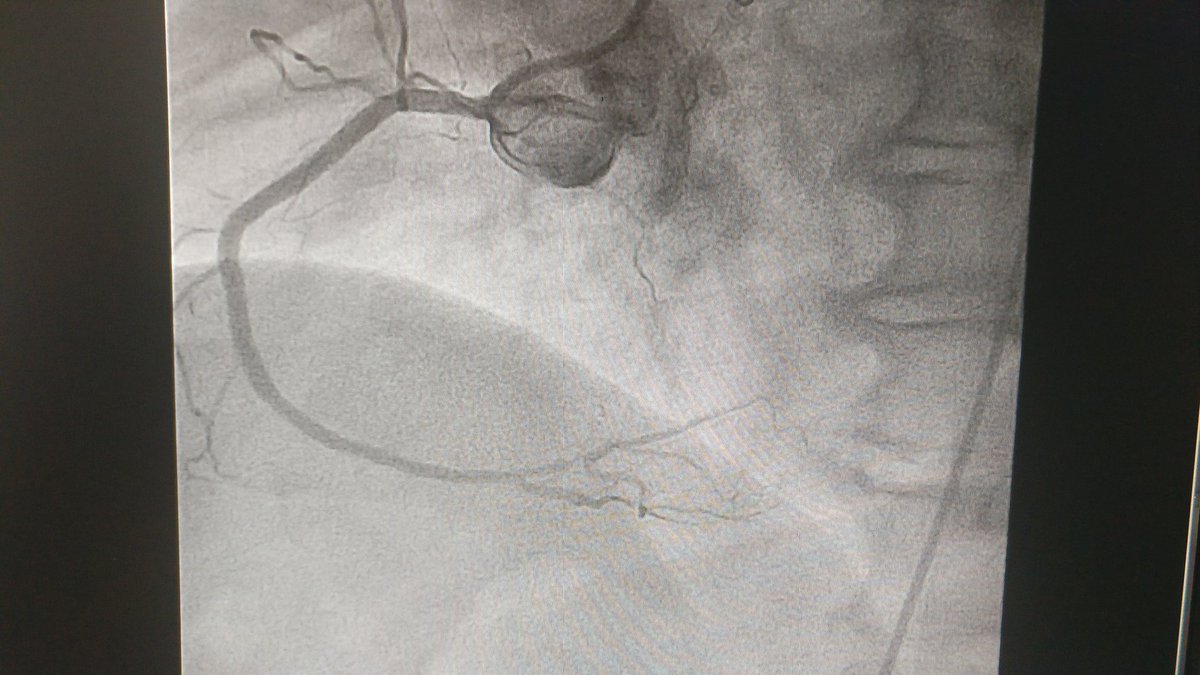 Juancar_Astorga's tweet photo. First case with ultrathin struts DES #SupraflexCruz at @GurutzetakoOsp. Superb performance in this complex #RCA #CTO. #AWE, Fielder XT went subintimal. Parallel wires with Progress80 over #TurnpikeSpiral. Good final result after 4 DES. @hemodinamicacr1 @Rblancomata @toroavispao https://t.co/y83QbABoEN