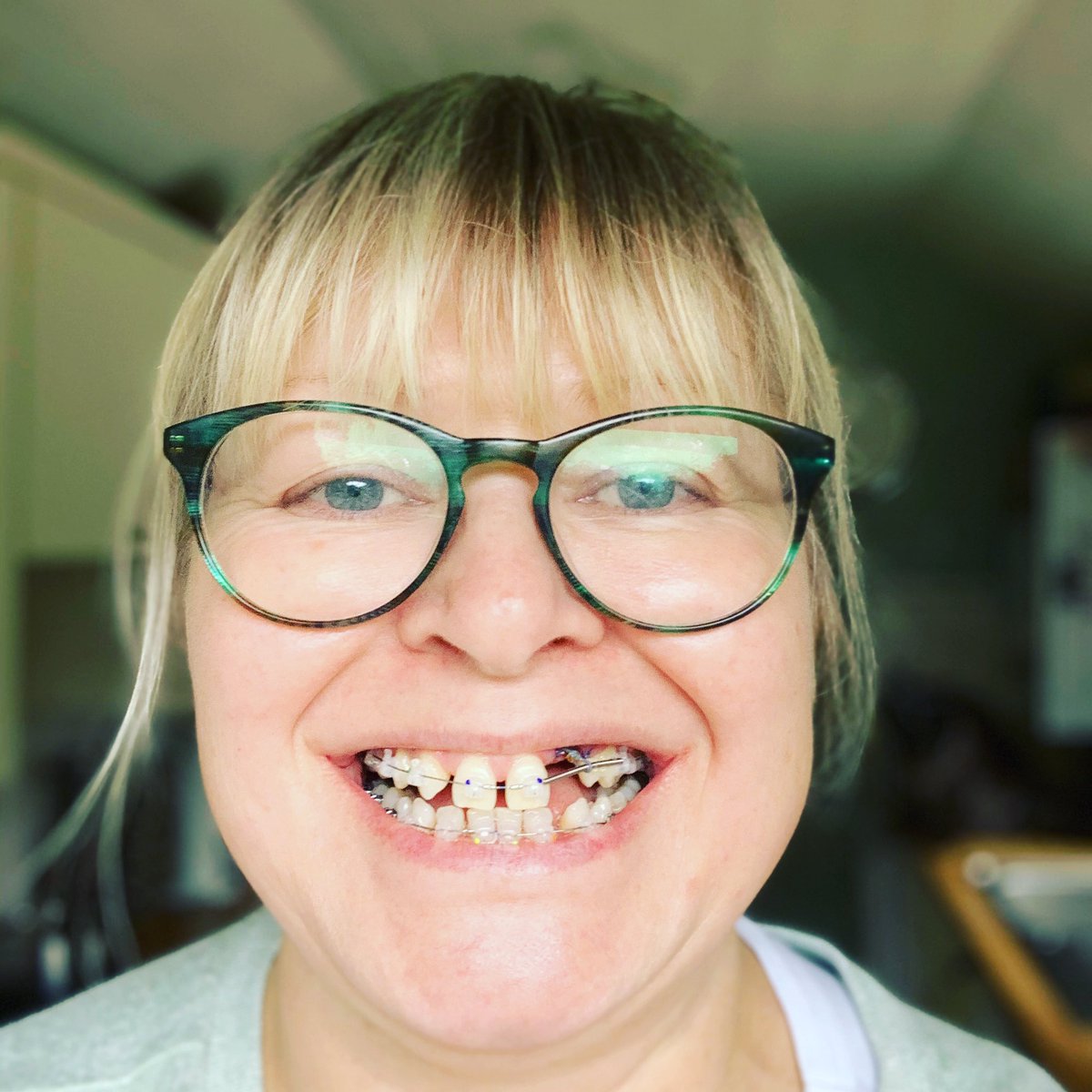jen73hynes's tweet photo. I can barely eat anything, I talk funny, my mouth is sore... never been happier! #gapfree https://t.co/jealXgPpJo