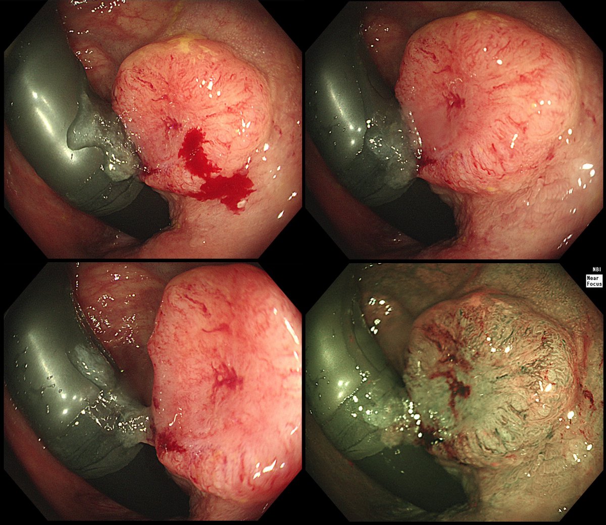 Endoscopy Brothers & Sisters tweet media