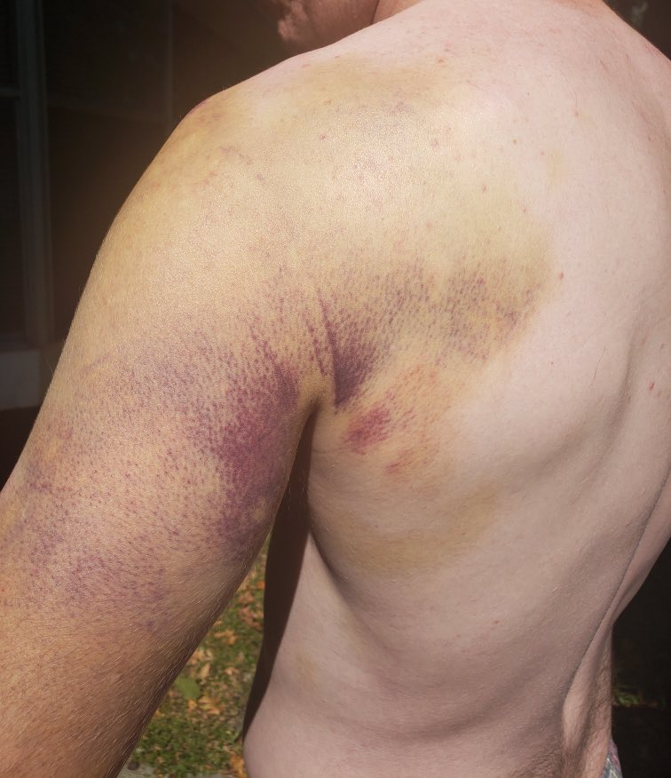 ashley__joseph's tweet photo. SHOCKING PHOTOS: Up to 10 Louisiana State Police cadets sought medical treatment for injuries after being “punished” when one cadet was found to have a prohibited cell phone in her possession.  
https://t.co/heXKeLX9na https://t.co/BEutGiZmpp