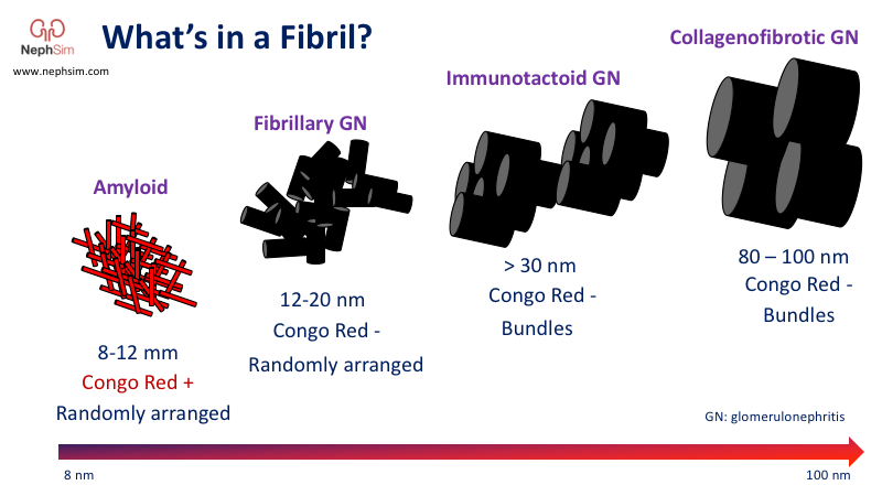 Studying for your #Nephrology boards next week and trying to remember those fibrils? 🤔

nephsim.com/image-gallery/

#FOAMed #Amyloidosis #Infographic  <a href="/grepmeded/">GrepMed</a>