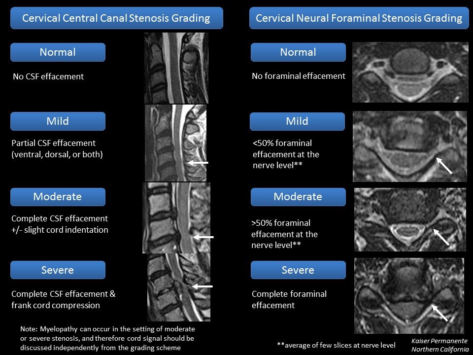 MarkMamloukMD's tweet image. Cervical #spine stenosis guide we created to implement consistent #radiology reporting across our multi-hospital network. Also included are 3 images from our lumbar stenosis guide from a couple years ago. While no "gold standard" exists, at least we can be consistent. @aboutKP