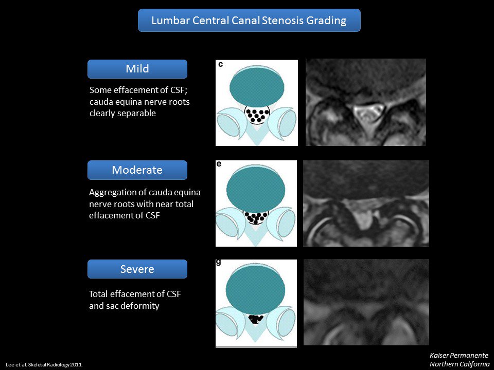 MarkMamloukMD's tweet image. Cervical #spine stenosis guide we created to implement consistent #radiology reporting across our multi-hospital network. Also included are 3 images from our lumbar stenosis guide from a couple years ago. While no "gold standard" exists, at least we can be consistent. @aboutKP