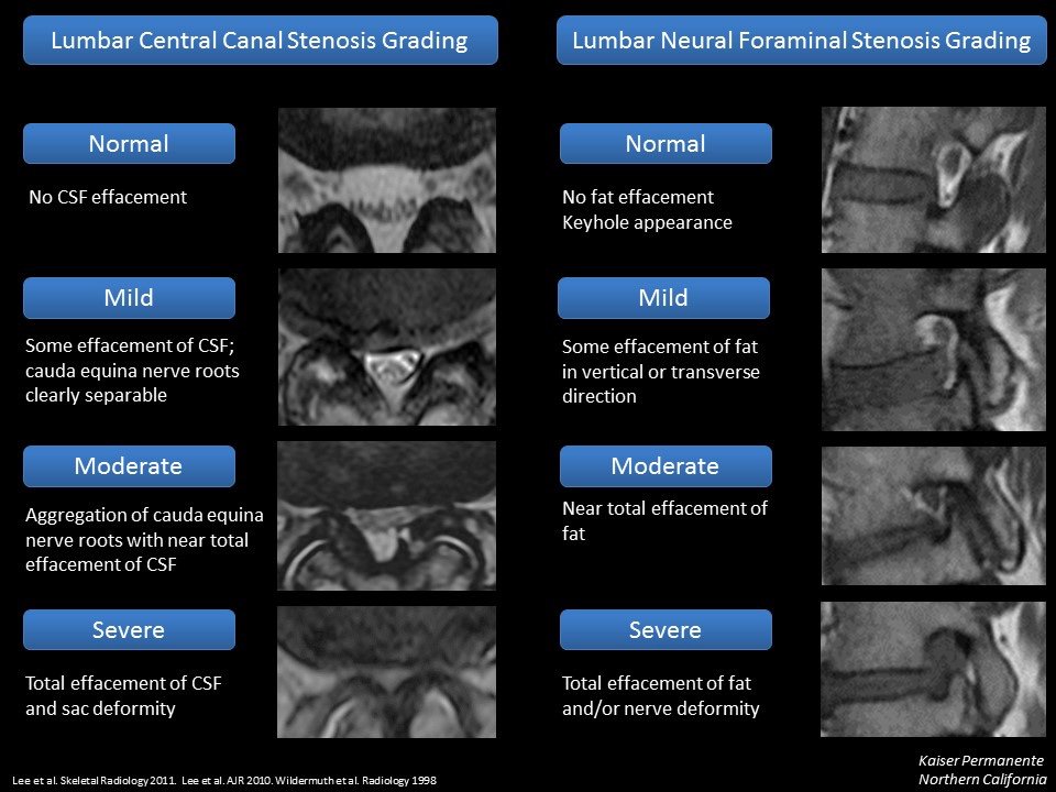 MarkMamloukMD's tweet image. Cervical #spine stenosis guide we created to implement consistent #radiology reporting across our multi-hospital network. Also included are 3 images from our lumbar stenosis guide from a couple years ago. While no "gold standard" exists, at least we can be consistent. @aboutKP