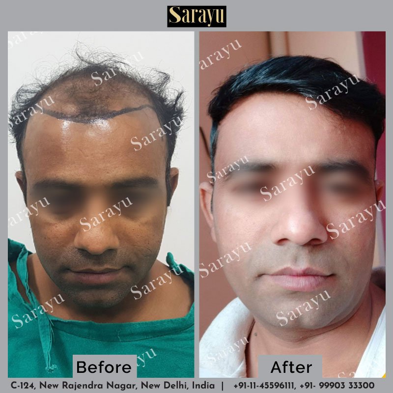 1500 Grafts ആദയതത 10 ദവസ Hair Line Reconstruction DrAthira  Sreenath  Hair O Dent  YouTube