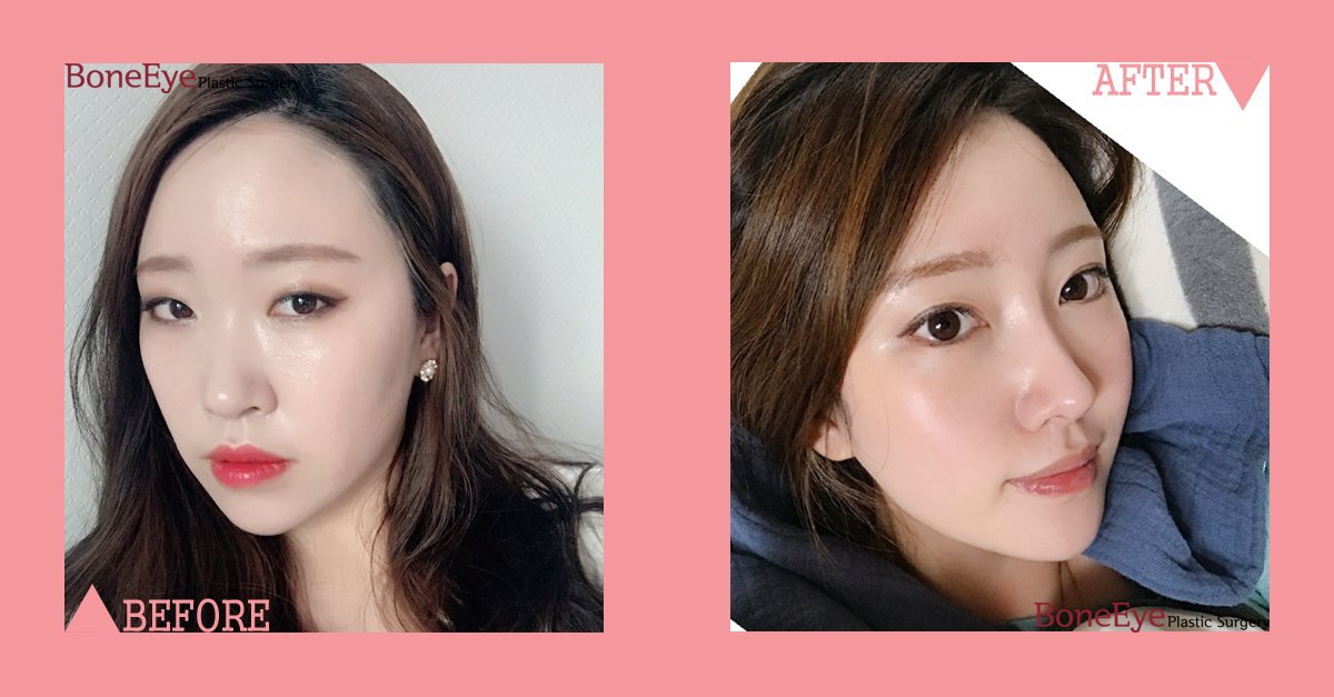BoneeyePlastic's tweet photo. 💞 When you meet BoneEye

✔️ eyes and nose done very well
✔️ what is your comment?

#boneeye #korean_surgeon #korean_plastic_surgery #korean_clinic #rhynoplasty_in_korea #doubleeyelids https://t.co/aI4hi9L6RB