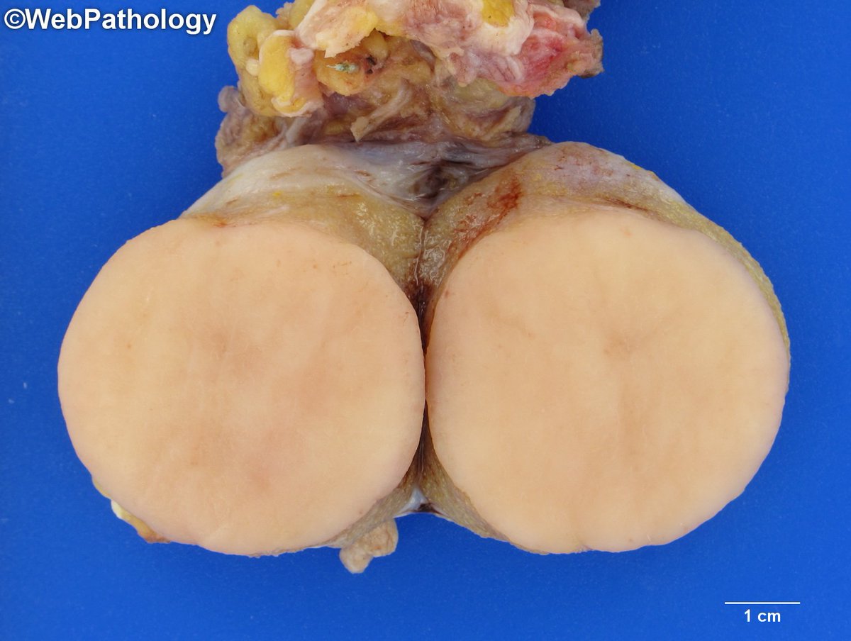 Nothing rare or unusual here.........just a Seminoma with classic gross appearance.......#gupath <a href="/Pathologists/">CAPathologists</a>
