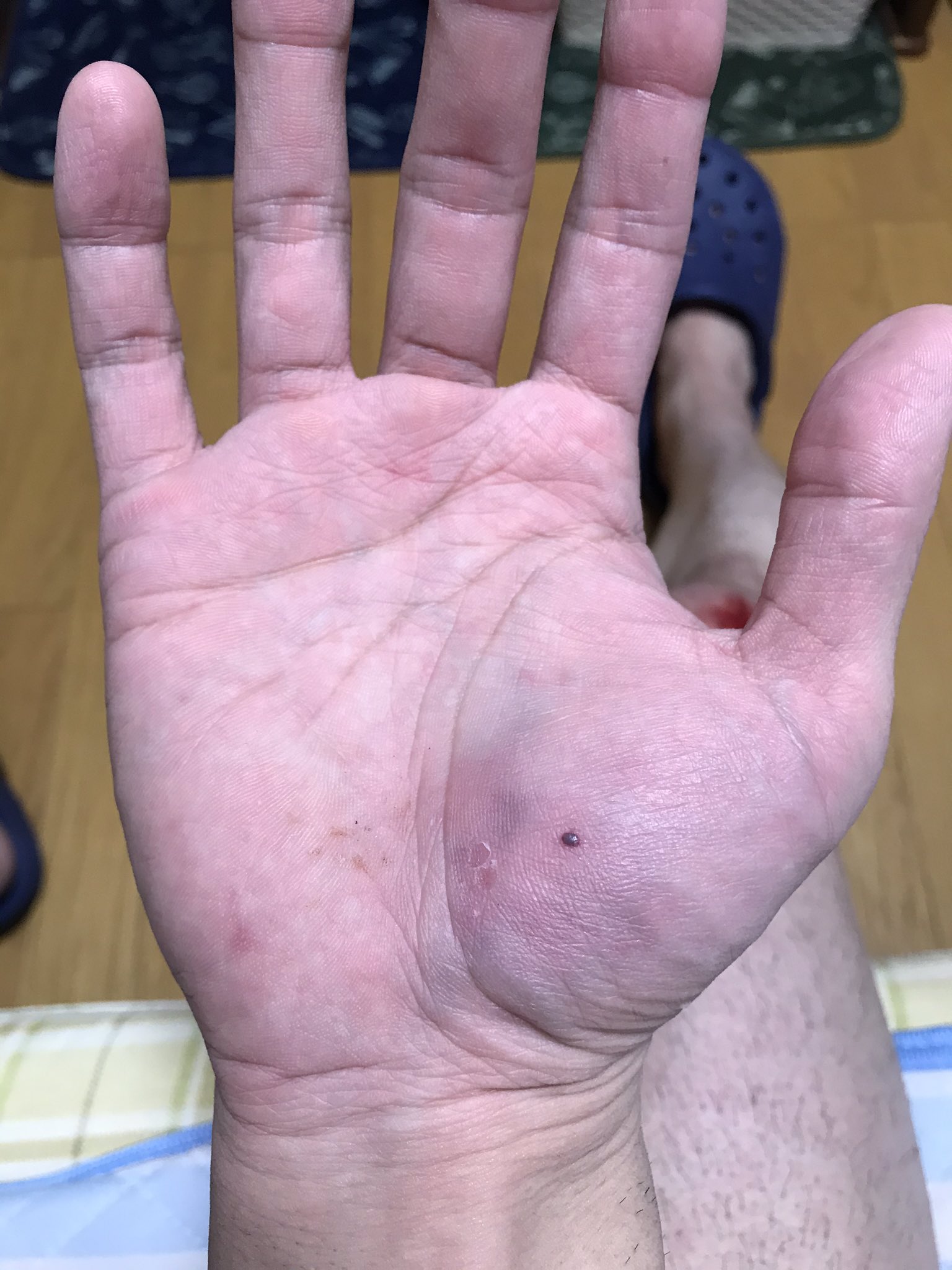 Taka No Twitter 今日の夕方買い物した帰りの道で曲がり角から急スピードで来た自転車 小学生ぐらい少年 を避けたまでは良かったんだけど その後直ぐに歩き直して入った道で転けて 膝と手の平を痛めた 膝は曲げる時に痛むし 手の平は