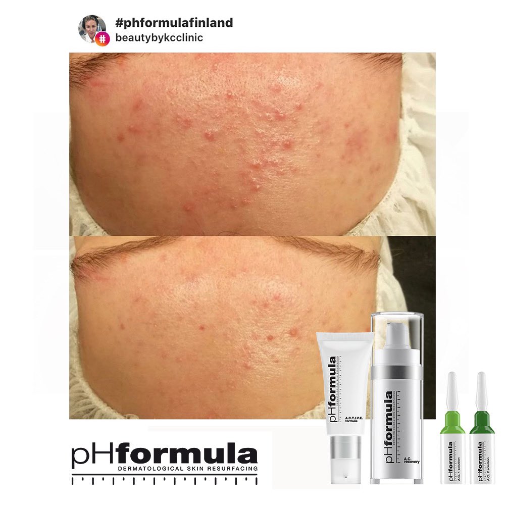pHformula в Twitter: „Excellent acne skin resurfacing results achieved by our skin specialists Finland. Thank you for sharing @beautybykcclinic #pHformula #skinresurfacing #artofskinresurfacing #pHformulaFinland #results #thankyou https ...