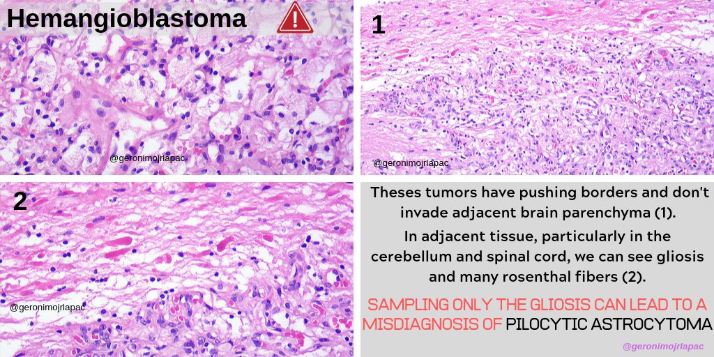 ⚠️PITFALL ALERT - CEREBELLAR HEMANGIOBLASTOMA⚠️
#Neuropath #pathology

Ps: Similar gliosis can be seen in ependymomas, gangliogliomas, low grade gliomas ...🧐🔬