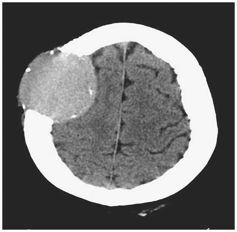 NEJM's tweet photo. From the #NEJMArchive: Plasmacytoma of the Skull https://t.co/qf1EXo83Yw https://t.co/T9xaNzwWbk
