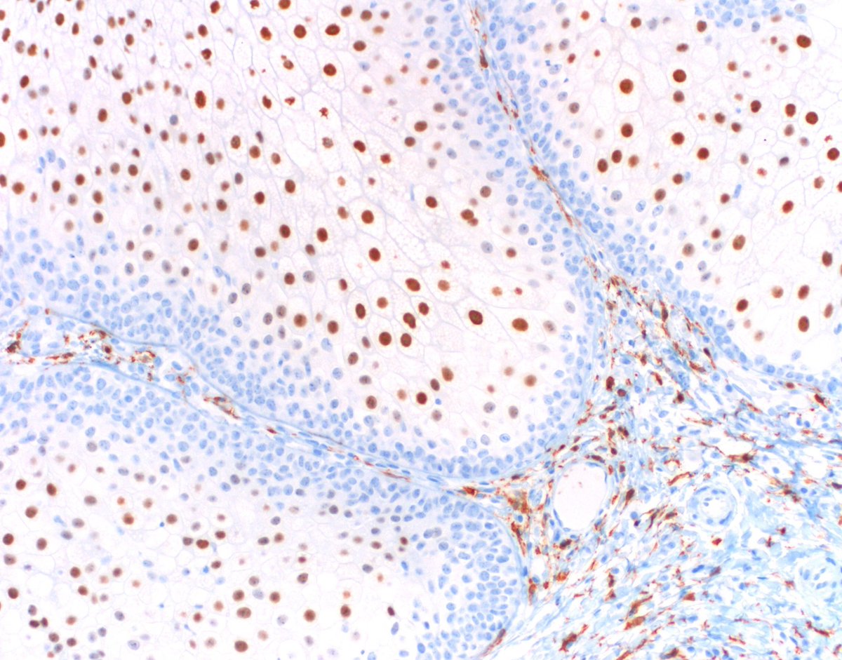 JMGardnerMD's tweet photo. Quiz: 1. What's the diagnosis? 2. What's the immunostain? #Pathology #dermpath #dermatology https://t.co/BlHk7evHWl