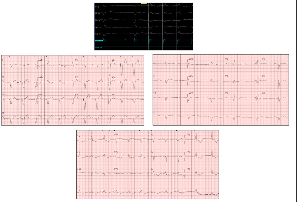 Amiloidosis TRT. Implante MP bicameral hace un año por BAV completo, con escape con morfología de BRDHH y HARI. Se nos remite por desplazamiento de electrodo AD y disfunción ventricular leve. Se realiza actualización con estimulación hisiana. Corrección de BRDHH y HARI